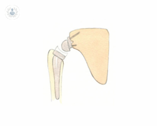 Descubre la aplicación de las prótesis de hombro dependiendo de la dolencia y las necesidades del paciente.