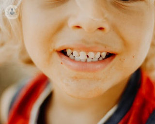 Los traumatismos o golpes en los dientes son la segunda causa de atención con el odontopediatra