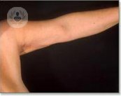 Se puede mejorar la imagen de brazos y manos a través de unas sencillas técnicas de medicina estética