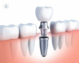 Conociendo a fondo la implantología dental