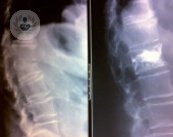 La cifoplastia es una técnica utilizada en el tratamiento de problemas de columna vertebral. Conoce todos los detalles en el siguiente artículo.