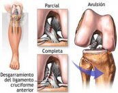 artroscopia rodilla