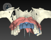 Conoce cómo se estudia la colocación de los implantes dentales a través de la tecnología 3D.