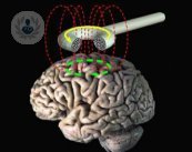 La estimulación magnética transcraneal se basa en la inducción electromagnética para activar las neuronas corticales, estimulando el córtex cerebral