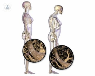 Huesos con Osteoporosis