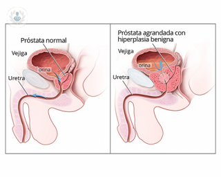 Hiperplasia Benigna de Próstata: cuando la próstata crece más de lo normal