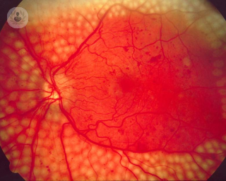 Como saber si tengo retinopatia diabética