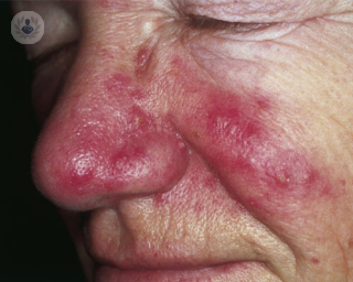 La rosácea es un problema dermatológico incómodo por su apariencia y localización facial. Descubre las innovaciones en el tratamiento de la rosácea.