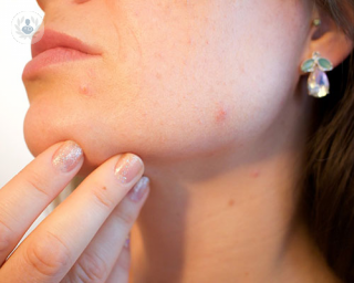 El tratamiento del acné se divide en terapia tópica, sistémica y terapia física para el acné y cicatrización. La experta doctora Coronas explica las soluciones.