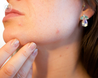 El acné se puede evitar siguiendo una alimentación saludable