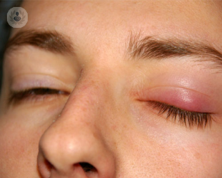 La ptosis parpebral consiste en la caída del párpado superior y puede provocar casos de ojo vago. Para corregirla se debe reforzar el músculo elevador del párpado.