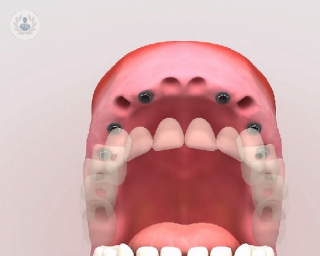 reconstrucción de dentadura con implantes dentales