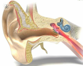 La osteoclerosis puede producir sordera y tratarse mediante la cirugia del vértigo, de la que se han tratado a miles de pacientes hasta la fecha. 