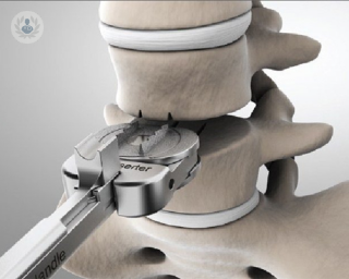 El doctor Arteaga nos explica qué son las prótesis de disco, unos dispositivos que permiten mantener la movilidad de la columna cervical y lumbar, cómo se colocan y en qué consiste el postoperatorio de la colocación de estas prótesis.