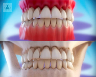 La periodontitis no suele causar dolor por lo puede pasar desapercibida. Por ello es esencial mantener un buen nivel de higiene bucal y acudir a revisiones periódicas.