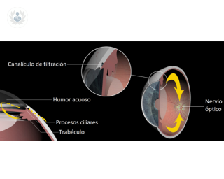 El glaucoma es una enfermedad ocular en la que se produce un aumento de presión intraocular