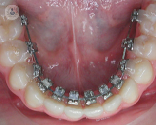 La ortodoncia lingual alinea los dientes colocando los brackets en la cara interior de los dientes - Top Doctors