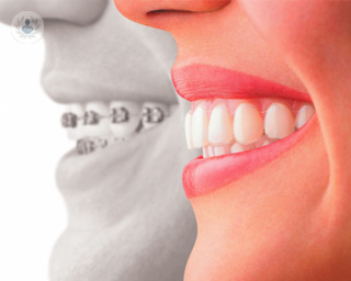La ortodoncia es un tratamiento muy común al que muchas personas necesitan someterse a lo largo de su vida