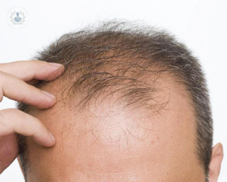 La alopecia androgenética es la calvicie común