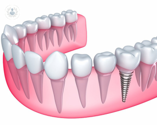 pilares de los implantes dentales | Top Doctors