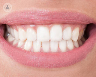 dientes blancos blanqueamiento dental
