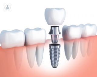 mantenimiento implantes dentales