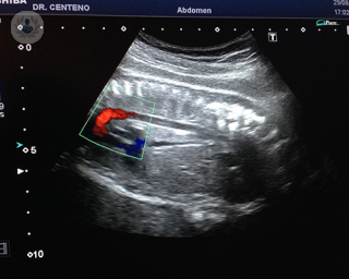 Qué es la ecocardiografía fetal