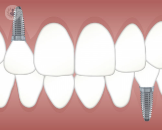 implantes dentales by top doctors