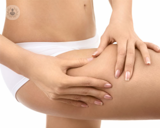 La celulitis afecta al 85-98% de las mujeres, siendo una desestructuración del tejido graso subcutáneo