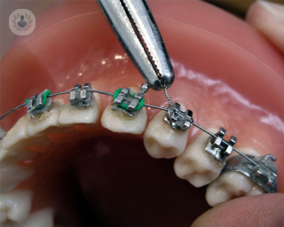 ortodoncia tradicional con brackets