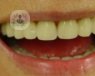 Recubrimiento dental con carillas y coronas para la estética dental