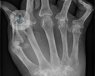 En este artículo el Dr. Martín Mola explica los síntomas y el tratamiento de la artritis reumatoide.