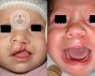 Lo que supone el antes y después de una operación exitosa del labio leporino.