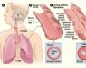 pulmones asma