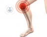 Entre los principales tratamientos para la artrosis de rodilla están los factores de crecimiento plaquetario y las prótesis de rodilla.