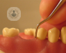 Existen tratamientos para la periodontitis, la enfermedad infeccioso-inflamatoria que afecta las encías y las estructuras de soporte de los dientes.