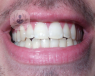 La bioestética soluciona con éxito los casos de desgaste dental que son erróneamente clasificados como bruxistas. También es adecuado este modelo terapeútico para 