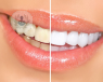 Los dientes pueden oscurecerse debido al tabaco u otras causas. Existe una gran variedad de técnicas para limpiar las manchas y conseguir unos dientes más blancos.