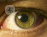 El desprendimiento de retina tiene un síntoma bien claro que es la pérdida de visión del área de esa retina desprendida. Pueden aparecer moscas volantes y destellos.
