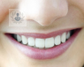 La sonrisa gingival afecta a 10 de cada 100 personas, las cuales sufren más allá de la estética, pues puede conllevar problemas en la boca del paciente