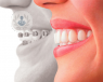 Los microtornillos se emplean como una alternativa eficaz a las tradionales técnicas de ortodoncia. La principal ventaja que ofrecen es reducir el tiempo de tratamiento