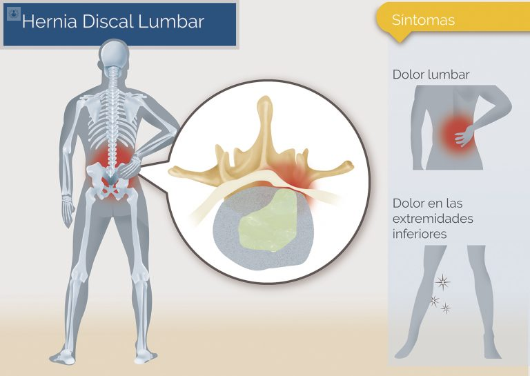 Síntomas de la hernia discal lumbar