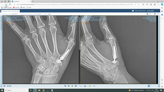 Imagen de artrosis de dedos de manos. Fuente: Dr. Almoguera