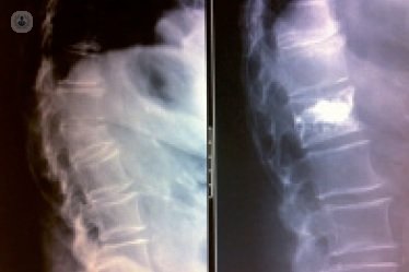 La cifoplastia es una técnica utilizada en el tratamiento de problemas de columna vertebral. Conoce todos los detalles en el siguiente artículo.