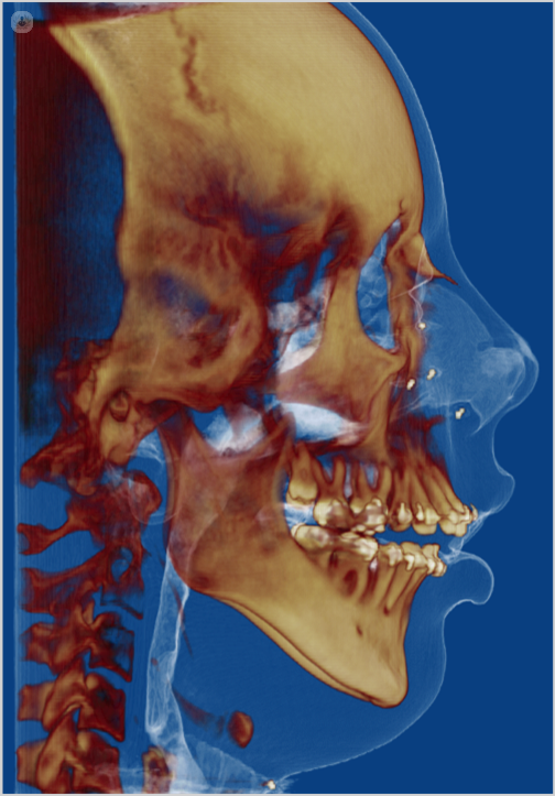 La cirugía ortognática es la técnica quirúrgica que mejora la posición incorrecta de la mandíbula. Descubre sus beneficios y riesgos en este artículo.