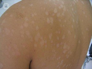 Hongos, una causa de manchas blancas en la piel