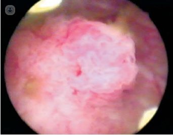 Endoscopic image of bladder cancer
