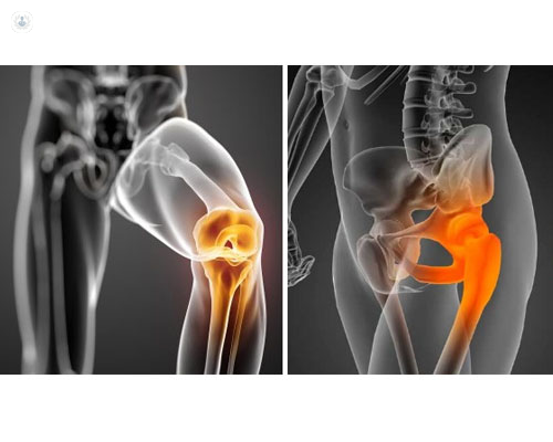 Imágenes de cadera y rodilla iluminados en los puntos con dolor - prótesis de rodilla y cadera by Top Doctors