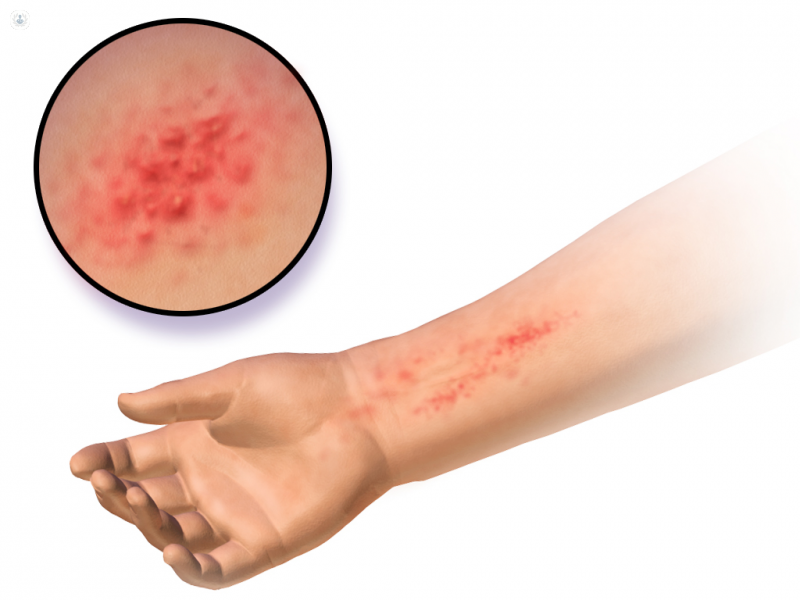 dermatitis alergica y contacto
