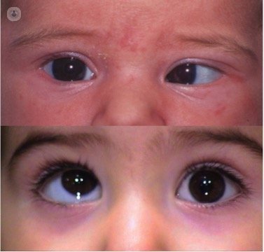 childhood strabismus